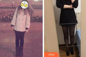 淮北東方美萊塢醫(yī)療美容醫(yī)院楊子偉整形價(jià)格表附吸脂案例展示