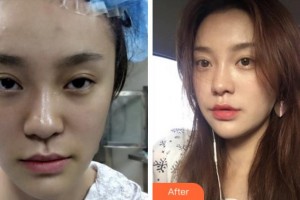 淮北東方美萊塢醫(yī)療美容醫(yī)院黨廣軒整形價(jià)格表附埋線提升案例展示