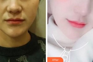 淮北天煌美容整形醫(yī)院吳長(zhǎng)淮整形價(jià)格表附熱瑪吉案例展示