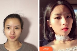 淮北天煌美容整形醫(yī)院吳雙純整形價(jià)格表附熱拉提案例展示