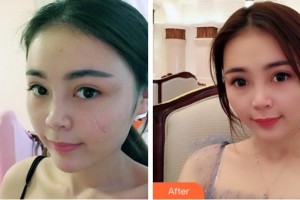 淮北奧斯曼醫(yī)療美容醫(yī)院任學(xué)東整形價(jià)格表附注射祛疤案例展示