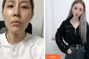 淮北時(shí)光整形美容醫(yī)院孟慶聚整形價(jià)格表附激光祛疤案例展示