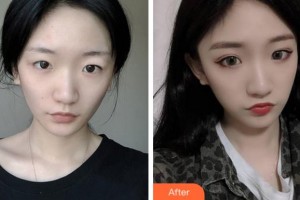 淮北市中醫(yī)院整形美容?？贫艜該P(yáng)整形價(jià)格表附切開(kāi)雙眼皮案例展示