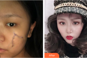 廣州軍美整形醫(yī)院何小建整形價(jià)格表附縫針疤痕案例展示