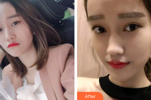 廣州愛康健口腔門診部李川整形價(jià)格表附時(shí)代天使矯正案例展示