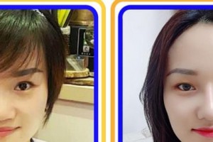 淮北美傾城醫(yī)療美容門(mén)診部李尚宇整形價(jià)格表附眼部整形案例展示