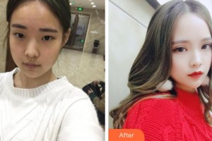 淮北博愛(ài)口腔醫(yī)院李龍整形價(jià)格表附切開(kāi)雙眼皮案例展示