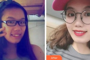 淮北博愛(ài)口腔醫(yī)院雷明光整形價(jià)格表附口腔矯正案例展示