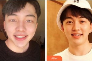 淮北博愛(ài)口腔醫(yī)院劉義整形價(jià)格表附美白貼片案例展示