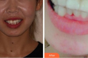 淮北愛(ài)美爾醫(yī)療美容門(mén)診部趙克儉整形價(jià)格表附牙齒隱形矯正案例展示