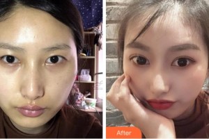 淮北愛(ài)爾眼科醫(yī)院高蓉整形價(jià)格表附眼部案例展示