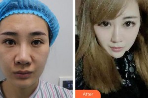 淮北愛(ài)爾眼科醫(yī)院張猛整形價(jià)格表附眼部綜合案例展示