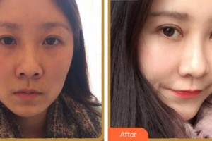 淮北愛(ài)爾眼科醫(yī)院魏林整形價(jià)格表附眼部綜合案例展示