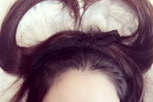 長沙宏朗眼科醫(yī)院王華整形價格表附切開雙眼皮案例展示