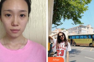 銅陵市人民醫(yī)院燒傷整形科錢(qián)尼文整形價(jià)格表附激光祛疤案例展示