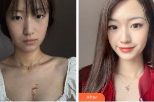 銅陵博愛(ài)醫(yī)院整形美容中心苗譯然整形價(jià)格表附微創(chuàng)疤痕修復(fù)案例展示