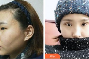 銅陵博愛醫(yī)院整形美容中心曹龍住院醫(yī)師整形價格表附切開雙眼皮案例展示