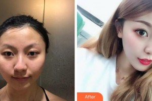 銅陵愛爾眼科醫(yī)院姜夏泉整形價格表附眼部整形案例展示