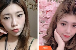 銅陵市婦幼保健院眼科張德明整形價格表附眼部綜合案例展示