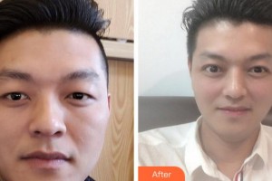 銅陵愛爾眼科醫(yī)院陶小林整形價格表附切開雙眼皮案例展示