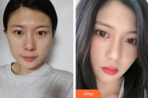 銅陵愛爾眼科醫(yī)院王莉勇整形價格表附眼部綜合案例展示