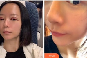 銅陵市立醫(yī)院眼科方劍峰整形價格表附切開雙眼皮案例展示