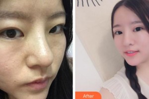 安慶亞星醫(yī)療美容門診部劉一正整形價格表附切開雙眼皮案例展示