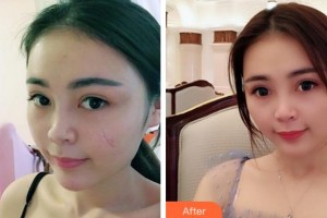 安慶石化醫(yī)院醫(yī)學(xué)美容中心丁應(yīng)忠整形價格表附注射祛疤案例展示