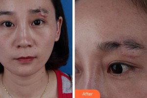 安慶亞星醫(yī)療美容門診部楊帆整形價格表附微創(chuàng)疤痕修復(fù)案例展示