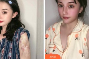 安慶石化醫(yī)院醫(yī)學(xué)美容中心楊賢金整形價格表附微創(chuàng)疤痕修復(fù)案例展示