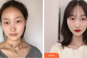 安慶維多利亞醫(yī)療美容門診部彭鵬整形價格表附祛疤案例展示