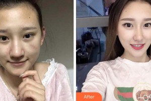 安慶維多利亞醫(yī)療美容門診部熊韜整形價格表附微創(chuàng)疤痕修復(fù)案例展示