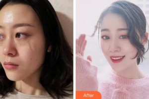 安慶維多利亞醫(yī)療美容門診部喬瑞整形價格表附激光祛疤案例展示