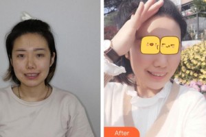 安慶渡江口腔醫(yī)院李永太整形價格表附牙齒矯正案例展示