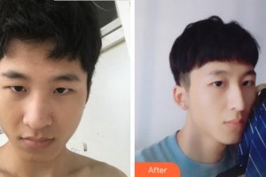 安慶現(xiàn)代婦產(chǎn)醫(yī)院整形美容中心林昌輝整形價格表附鼻部整形案例展示