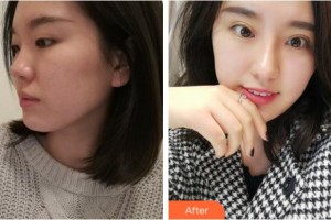 安慶施漢彬愛爾眼科醫(yī)院施漢彬整形價格表附眼部綜合案例展示