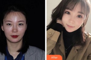 安慶市第二人民醫(yī)院眼科袁俊整形價格表附切開雙眼皮案例展示