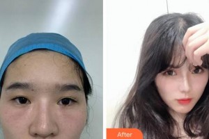 安慶市第二人民醫(yī)院眼科劉少勤整形價格表附雙眼皮案例展示