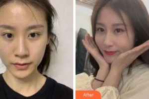 安慶市第二人民醫(yī)院眼科江兆源整形價格表附切開雙眼皮案例展示