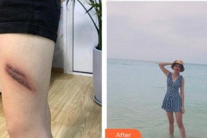 黃山市人民醫(yī)院整形科余發(fā)強整形價格表附祛疤案例展示