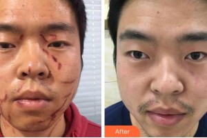 黃山市人民醫(yī)院整形科邊貝奇整形價格表附微創(chuàng)疤痕修復(fù)案例展示