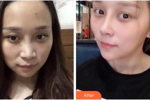 黃山心藝醫(yī)療美容門診部張斌斌整形價格表附肋軟骨隆鼻案例展示