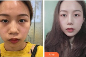 黃山藝美人整形醫(yī)院封晴平整形價格表附鼻部綜合案例展示