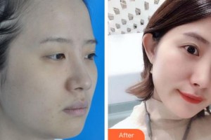 黃山市第三人民醫(yī)院眼科丁勝鵬整形價格表附眼部綜合案例展示