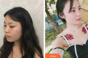 黃山市第三人民醫(yī)院眼科江啟孝整形價格表附眼部綜合案例展示