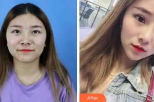 滁州伊爾美整形醫(yī)院孫洪香整形價格表附切開雙眼皮案例展示