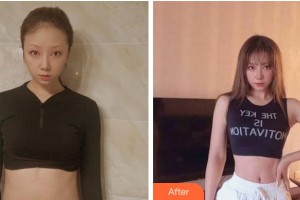 滁州市第一人民醫(yī)院燒傷整形科姚廣東整形價格表附微創(chuàng)疤痕修復(fù)案例展示