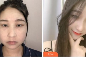 阜陽市人民醫(yī)院整形美容外科方建強(qiáng)住院醫(yī)師整形價格表附埋線提升案例展示