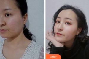 阜陽皮膚病醫(yī)院醫(yī)療美容科王峰整形價格表附抗衰案例展示