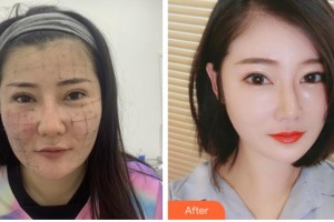 阜陽東方美萊塢醫(yī)療美容醫(yī)院袁艷整形價格表附熱瑪吉案例展示